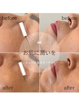 ビアージュ ナガクテ(Beage nagakute)/フェース生コラフェイシャル