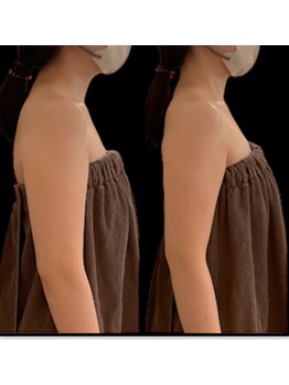 ジーニー(Genie)/美容骨格矯正＃巻肩編