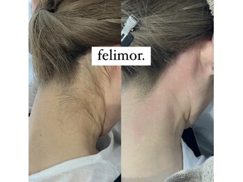 フェリモール(Felimor.)/シュガーリングbefore／after