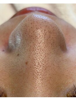 ルチル(Rutile)/韓国式3D毛穴洗浄