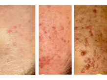 サロンド ヴィーナス 葛西店/悩みのニキビケアも頼ってほしい