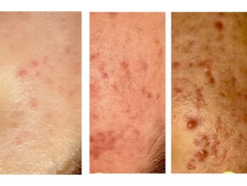 サロンド ヴィーナス 葛西店/悩みのニキビケアも頼ってほしい