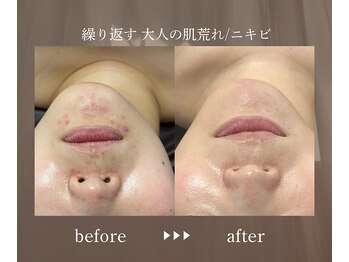 エメ(eme)/emeで肌荒れに終止符を