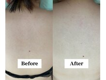 ワイイーサロン(Y/E SALON)/【20代女性　全身脱毛】