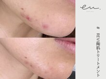 エム(eM.)/REVI陶肌トリートメント５日後