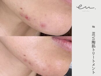 エム(eM.)/REVI陶肌トリートメント5日後