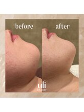 ウリ(uli beauty)/比較写真