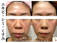 ローズフィールド(Rosefield)/RFピール/ニキビ/シミ/毛穴