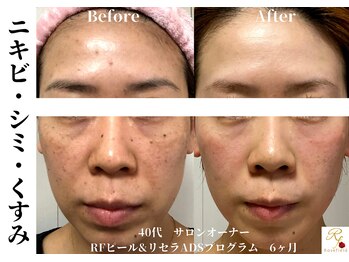 ローズフィールド(Rosefield)/RFピール/ニキビ/シミ/毛穴