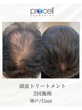 ユミト(Umit)/プロセルスカルプ