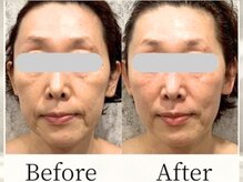 ドゥシール(Docile)の雰囲気(50代のほうれい線・たるみ 改善/モニター様の一例※個人差あり)