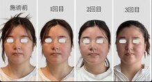 リフェイス(RE:FACE)