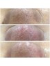 夏の毛穴ケア、毛穴洗浄で角栓のお掃除でつるんと肌