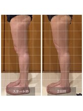 ルリアンデュレ(le lien durer)/下半身2回目の施術後