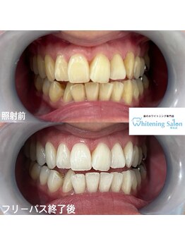 ホワイトニングサロン 熊本店/遅くないホワイトニング