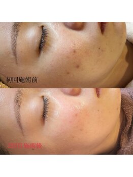 ピュール 鯖江店(PUR)/肌質改善/光フェイシャル