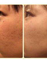 スムース イー(Smooth+E)/学割本気ニキビケアセット！