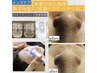 メンズNo.1【ハイドロスプラッシュ毛穴洗浄&乳酸ピーリング】毛穴&シミケア◎