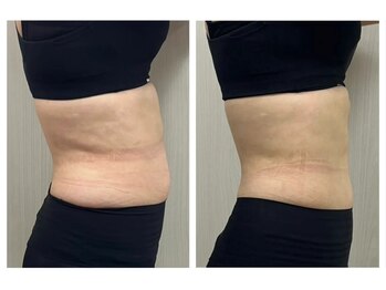 ネオン(Neon)/効果抜群!脂肪冷却1回