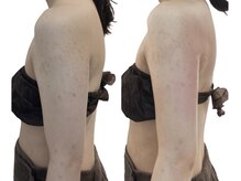 痩せラボ/振り袖肉を無くす【痩身】