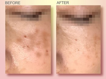 ジュリア オージェ 天王寺店/ビフォーアフター（シミケアP)