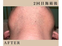 リノ(Lino)/3回で9900円