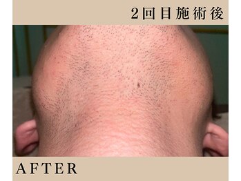 リノ(Lino)/3回で9900円