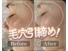 当店人気No1【シワたるみケア/透明感UP】美容鍼×セルマンフェイシャル¥11000