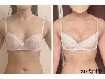 リール 新宿店(RIRE)/30代前半 バストアップ症例