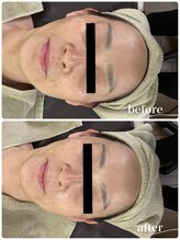 ジャスミン(Jasmin)/臍帯血幹細胞×NMN×AC-11