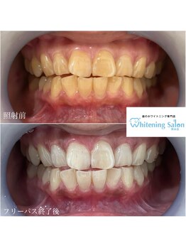 ホワイトニングサロン 熊本店/友達とホワイトニング
