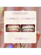 プラスビー 2号店(+b)/ホワイトニングビフォーアフター