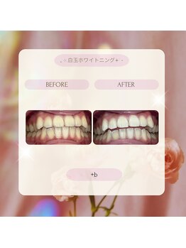 プラスビー 2号店(+b)/ホワイトニングビフォーアフター