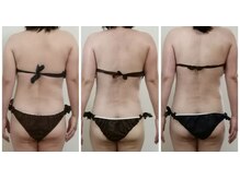 ビューティールーム 優美/痩身コース　ビフォーアフター