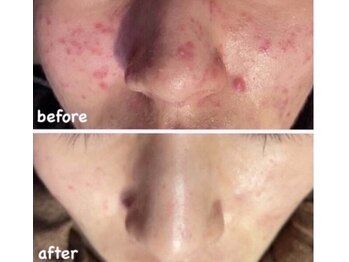 マリエンドリー/ニキビ肌改善◎