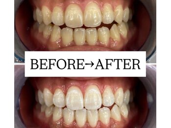 ホワイトニングサロン 宝塚/Before&After美白ホワイトニング