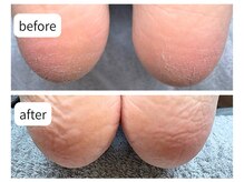 カシェット(Cachette)/30代女性◎足裏角質ケア90分