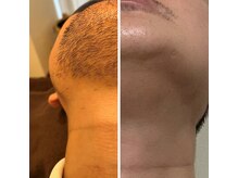 ウルル(Ululu)/【メンズ脱毛】脱毛経過　6ヵ月