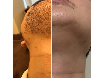 ウルル(Ululu)/【メンズ脱毛】脱毛経過　6ヵ月