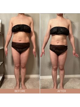 リファラ 光の森店(REFALA)/【痩身/20代女性】約3ヶ月の結果