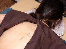 美心鍼/鍼が苦手