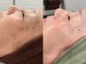 【年齢肌サインに先手】シミケアとお肌にハリを。エイジングケアフェイシャル