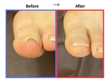 サロンソワ(salon Soi.)/巻き爪ケア