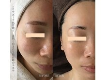 美容医療ゼロで叶う健康素肌★業界No.1「リアボーテ」