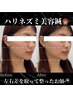 美容始めました！7月限定美容キャンペーン 微細針40本 ￥5,500　20名限定！
