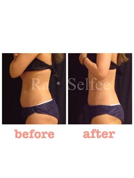 ラ セルフィー(Ra Selfee)/パルス痩身マグブレイク症例