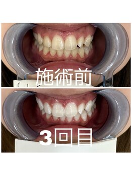 ルナ(LUNA)/比較してビックリ！