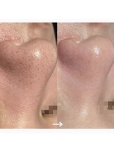 モーヴ(MAUVE)/韓国式３D毛穴洗浄