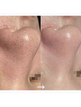 モーヴ(MAUVE)/韓国式3D毛穴洗浄