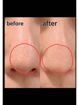 シス(SiS.)/ハーブピーリング